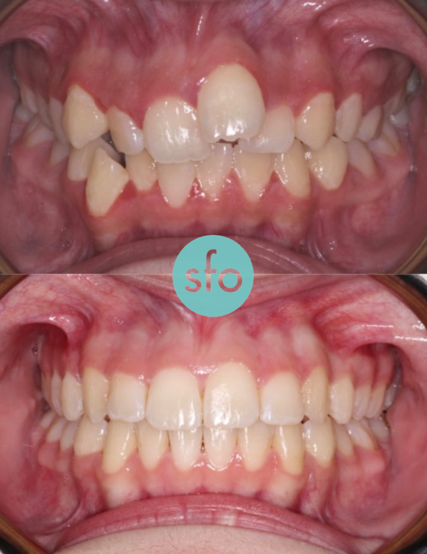 Before and after orthodontics treatments - first