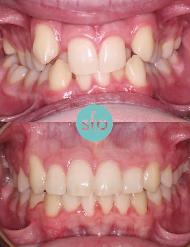 Before and after orthodontics treatments - second