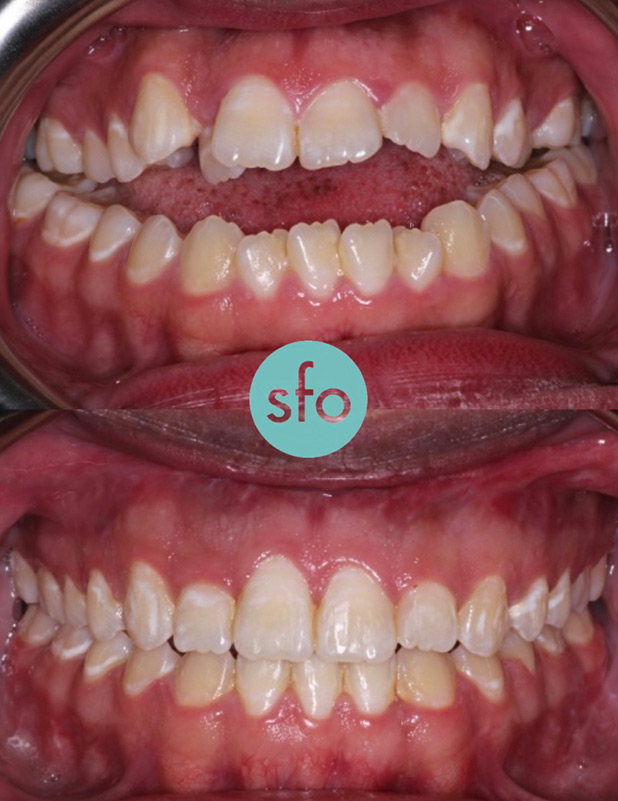 Before and after orthodontics treatments - third
