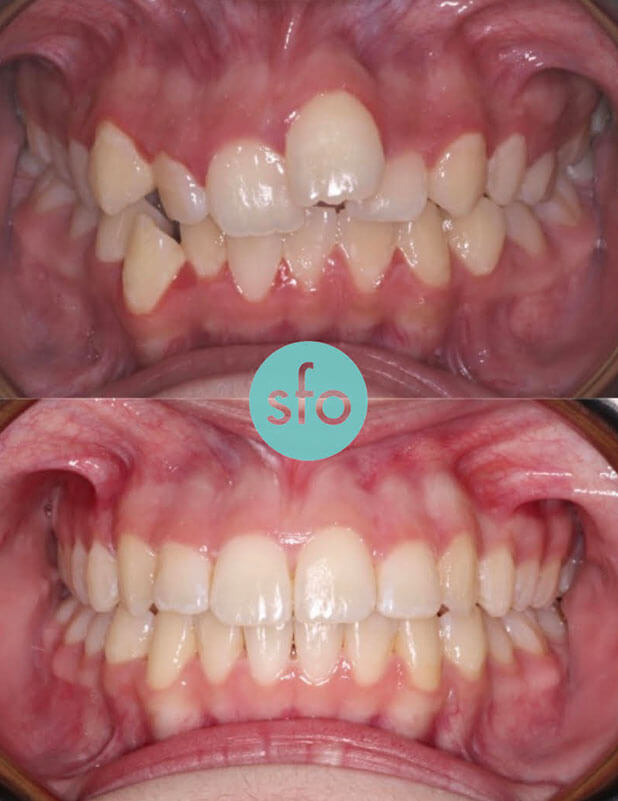 before after aligner treatment image