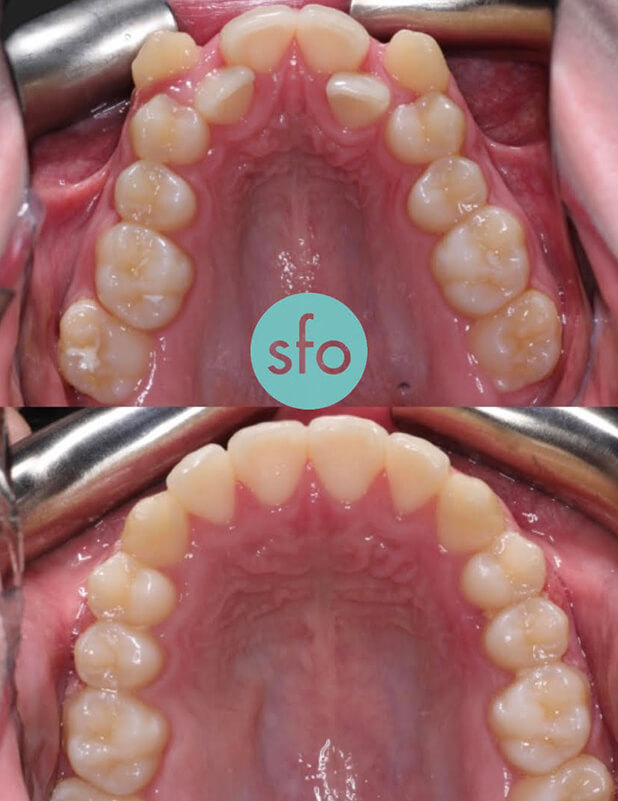 before after expander braces clean image