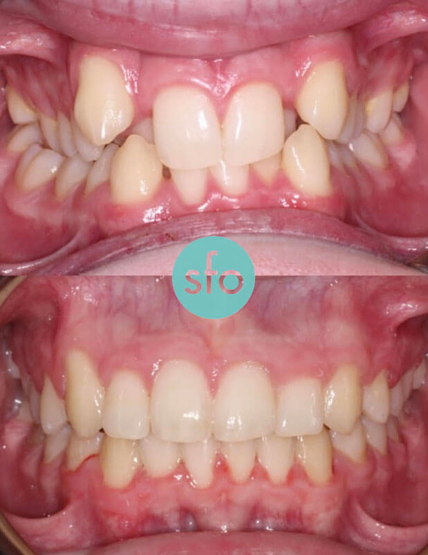 before after expander braces treatment front image