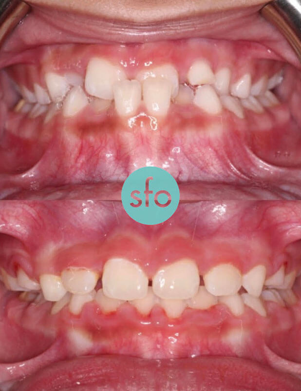 before after expander braces treatment phase image 1