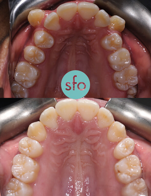 before after occlusal extraction image