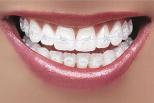 ceramic braces image