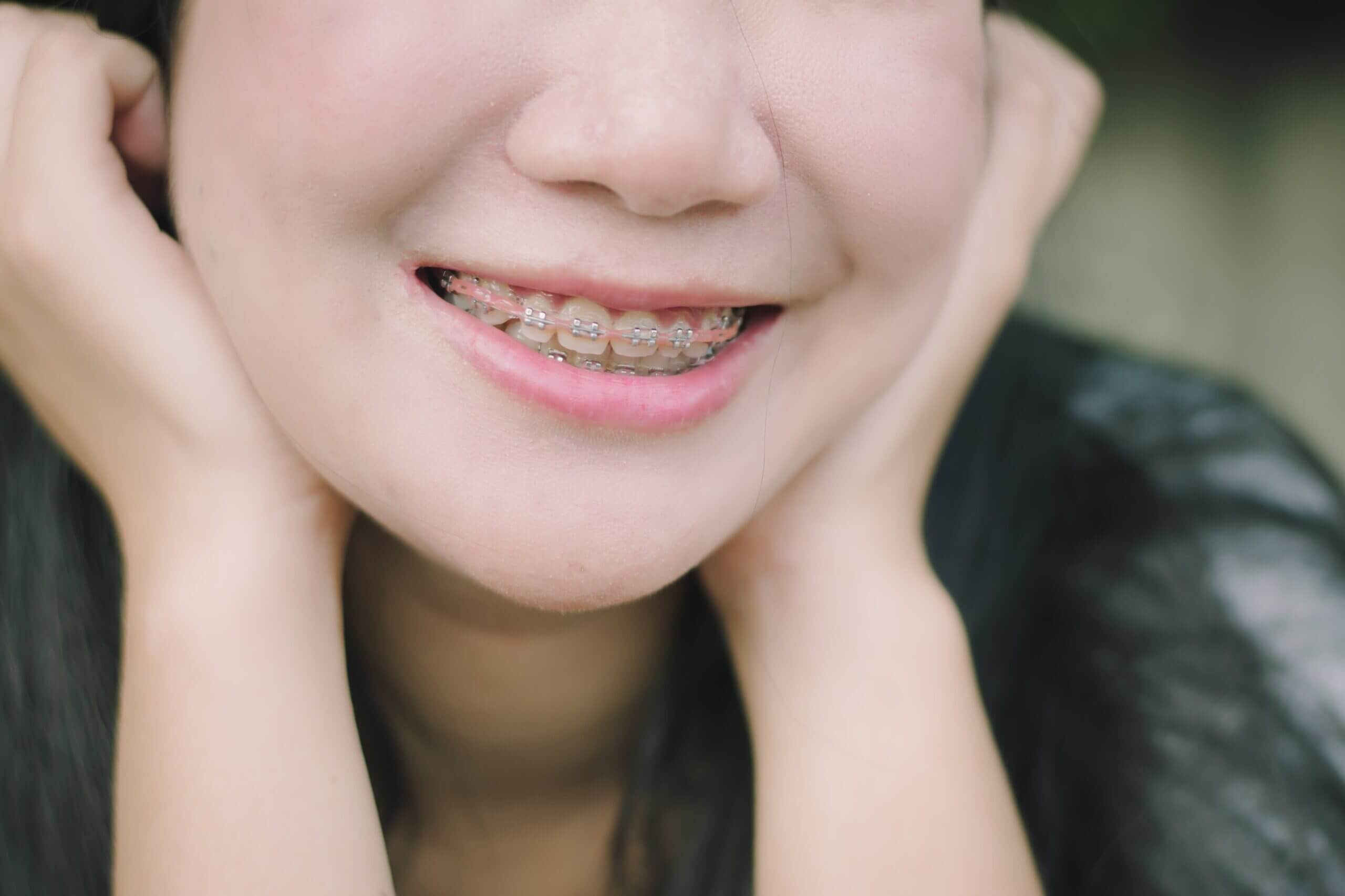 happy smile of young woman with dental braces image