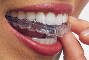 invisalign image