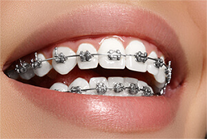 metal braces image 1